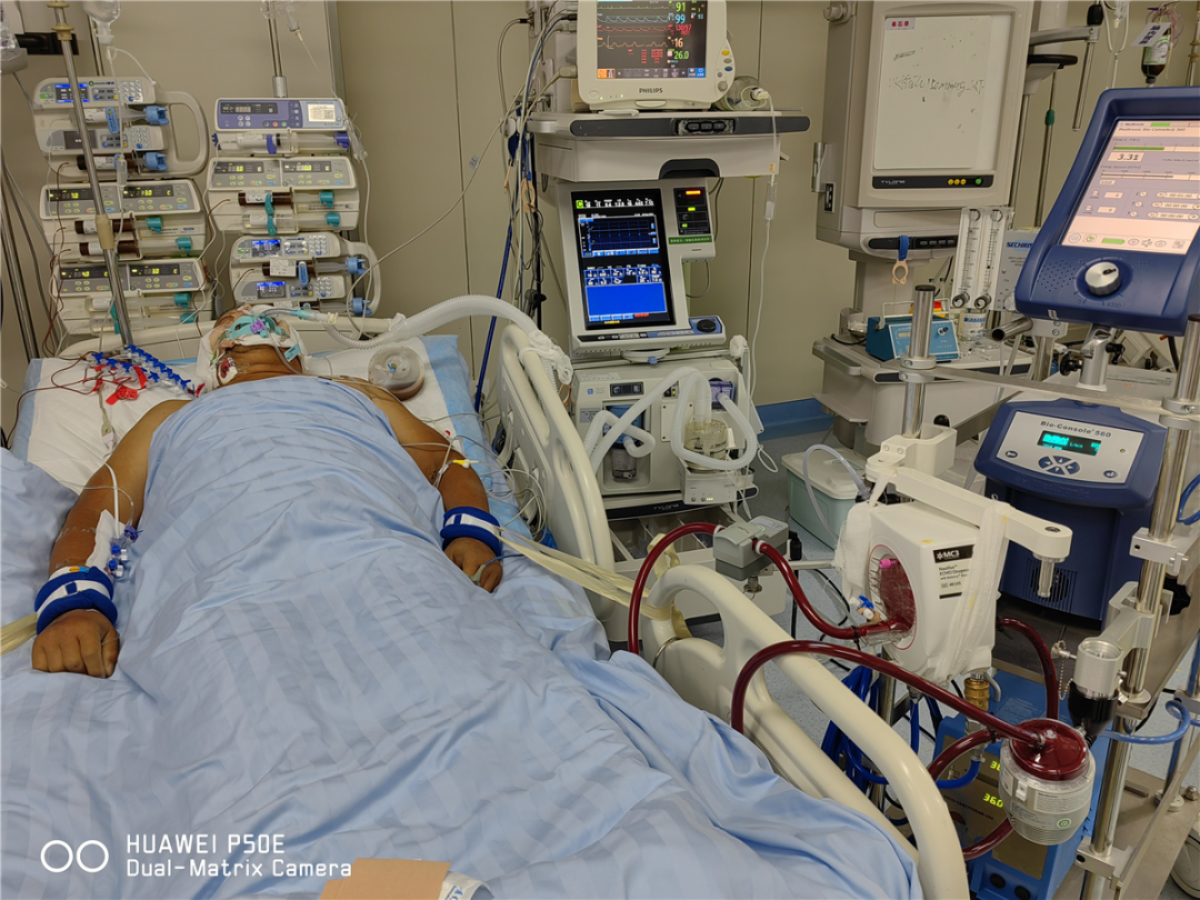 辅助绝地求生 首例！急性心肌梗死患者起死回生，ECMO 辅助治疗再创生命奇迹